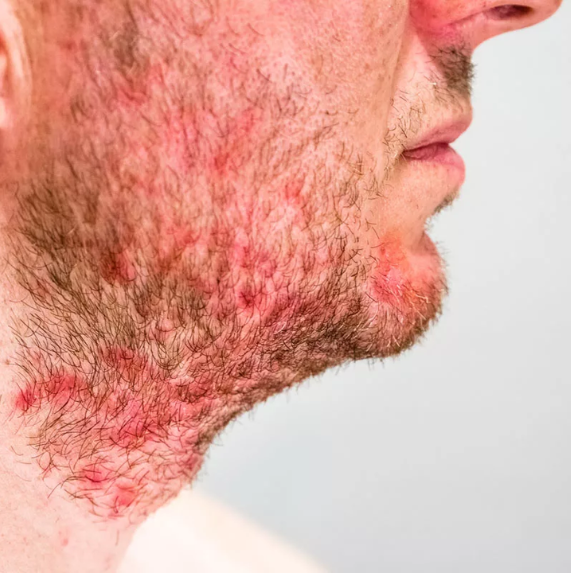 about-eczema-face