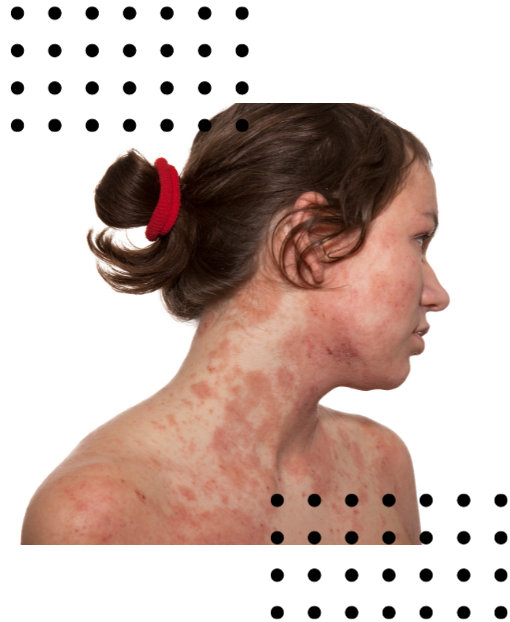 eczema-diet-woman